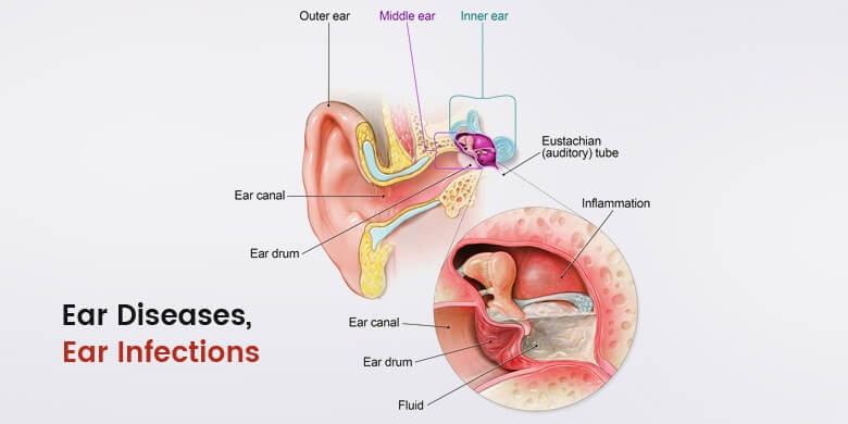 Ear Diseases Ear Infections Causes Symptoms And Treatments 1910