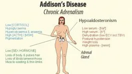 Addison's Disease Causes, Diagnosis, Symptoms, Treatment