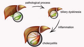 gallbladder cholecystitis chronic condition shrinks attacks acute occurs several after