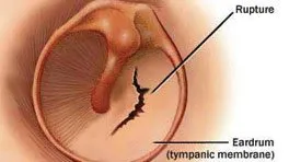 Ear Infection, Ear Diseases