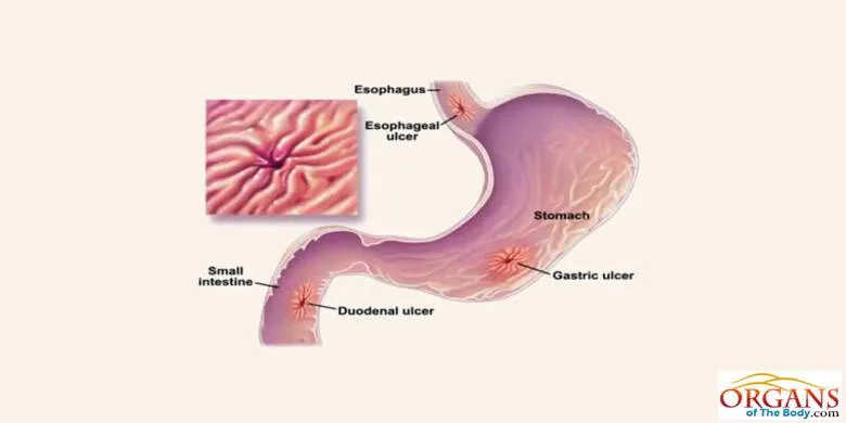 Stomach Diseases Or Disorders