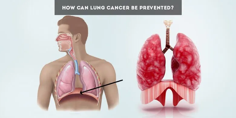 Learn How Can Lung Cancer Be Prevented With Some Simple Steps