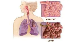 Common Lung Diseases in The World
