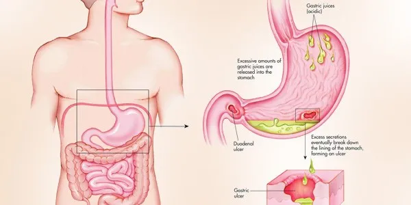 Stomach Ulcer Diet And Precautions